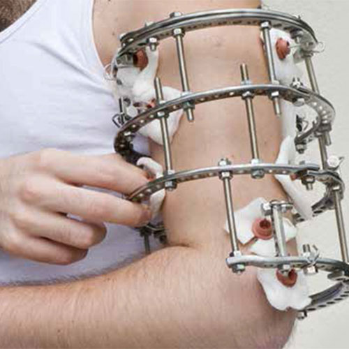 Limb reconstruction surgery